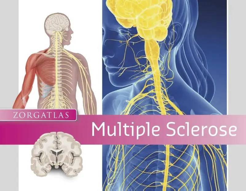 Multiple Sclerose